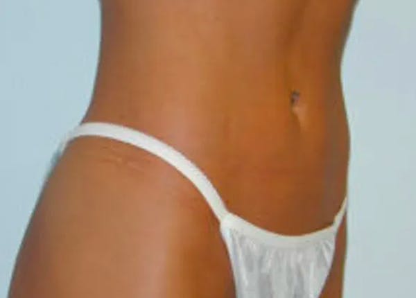 Liposuction Before & After Gallery - Patient 4726796 - Image 4