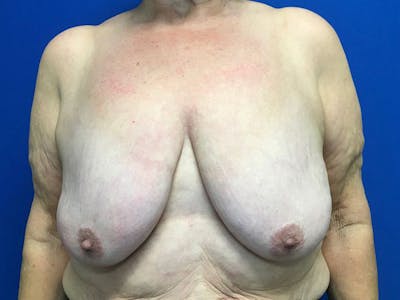 Mastopexy Before & After Gallery - Patient 64199219 - Image 1