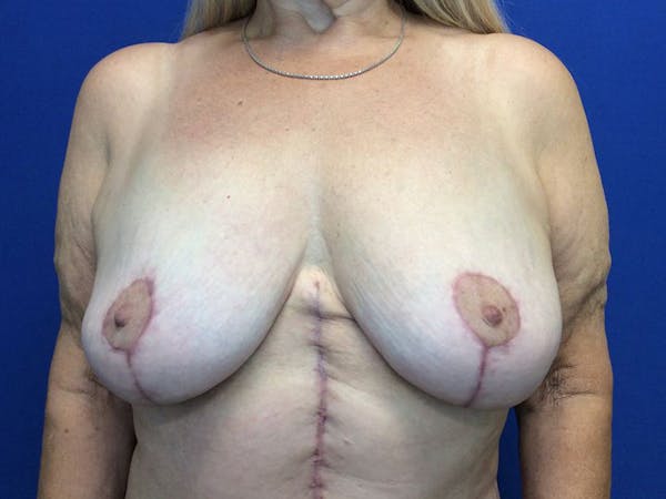 Mastopexy Before & After Gallery - Patient 64199219 - Image 2