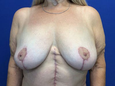 Mastopexy Before & After Gallery - Patient 64199219 - Image 2