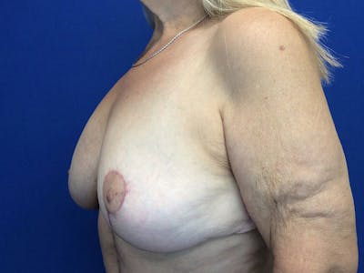 Mastopexy Before & After Gallery - Patient 64199219 - Image 4