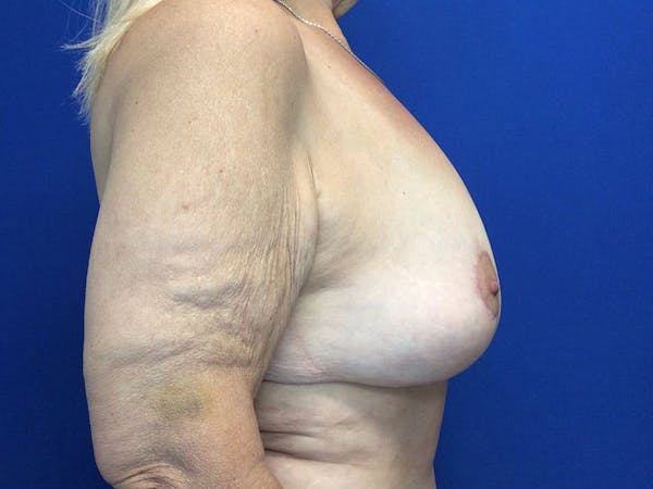 Mastopexy Before & After Gallery - Patient 64199219 - Image 8