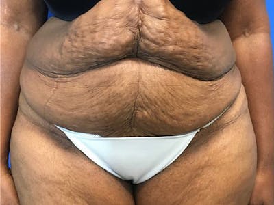 Tummy Tuck (Abdominoplasty) Before & After Gallery - Patient 65237471 - Image 1