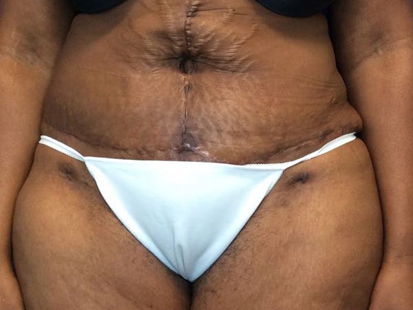 Tummy Tuck (Abdominoplasty) Before & After Gallery - Patient 65237471 - Image 2