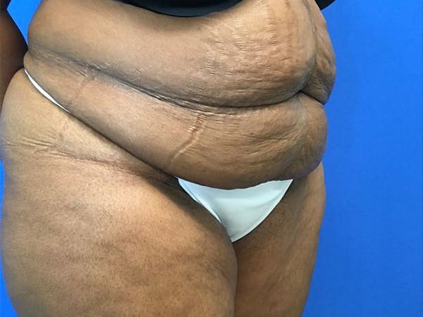 Tummy Tuck (Abdominoplasty) Gallery - Patient 65237471 - Image 3