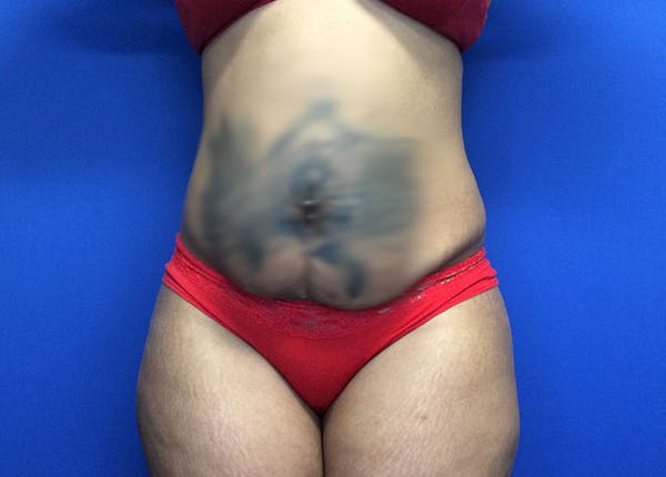 Liposuction Gallery - Patient 65565133 - Image 1