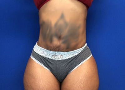 Liposuction Before & After Gallery - Patient 65565133 - Image 2