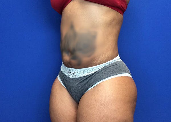 Liposuction Before & After Gallery - Patient 65565133 - Image 4
