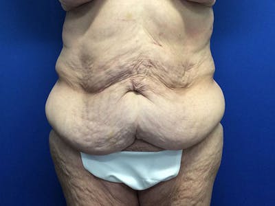 Tummy Tuck (Abdominoplasty) Before & After Gallery - Patient 80650405 - Image 1