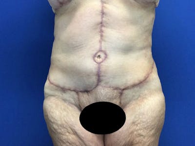 Tummy Tuck (Abdominoplasty) Before & After Gallery - Patient 80650405 - Image 2