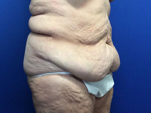 Tummy Tuck (Abdominoplasty) Gallery - Patient 80650405 - Image 3