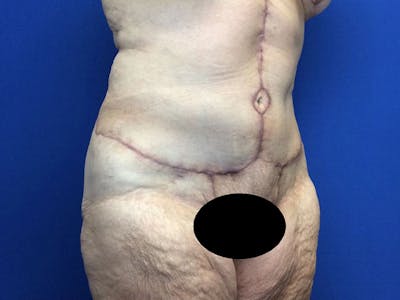Liposuction Before & After Gallery - Patient 80650403 - Image 4