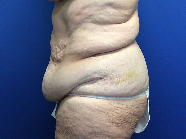 Liposuction Before & After Gallery - Patient 80650403 - Image 5