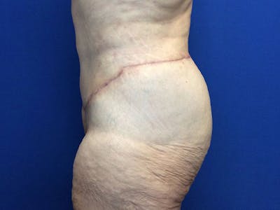 Liposuction Gallery - Patient 80650403 - Image 6