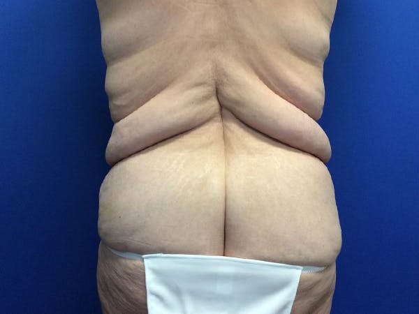 Tummy Tuck (Abdominoplasty) Before & After Gallery - Patient 80650405 - Image 7