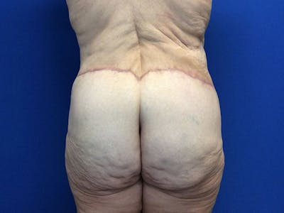 Tummy Tuck (Abdominoplasty) Before & After Gallery - Patient 80650405 - Image 8