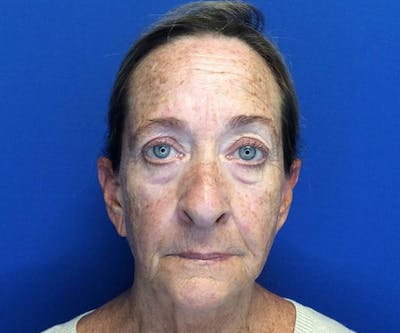 Thread Lift Before & After Gallery - Patient 80650708 - Image 1