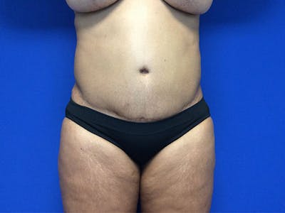 Liposuction Before & After Gallery - Patient 81511483 - Image 1
