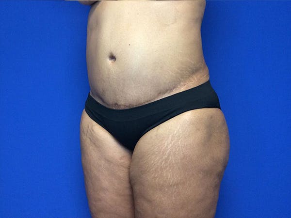 Liposuction Before & After Gallery - Patient 81511483 - Image 3