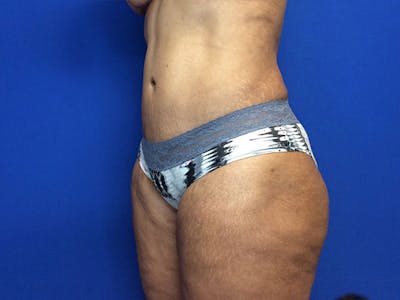 Liposuction Before & After Gallery - Patient 81511483 - Image 4