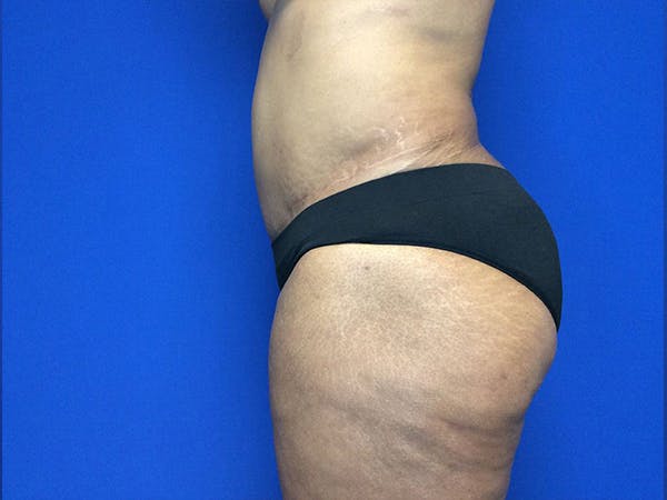 Liposuction Before & After Gallery - Patient 81511483 - Image 5