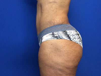 Liposuction Before & After Gallery - Patient 81511483 - Image 6