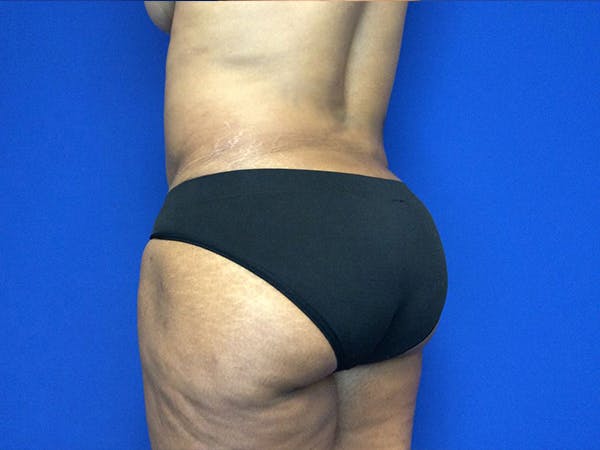 Liposuction Gallery - Patient 81511483 - Image 7
