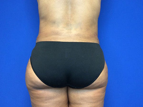 Liposuction Gallery - Patient 81511483 - Image 9