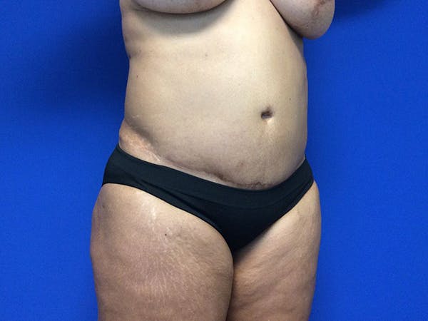 Liposuction Before & After Gallery - Patient 81511483 - Image 11