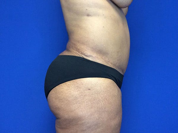 Liposuction Gallery - Patient 81511483 - Image 13