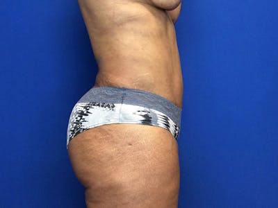 Liposuction Before & After Gallery - Patient 81511483 - Image 14