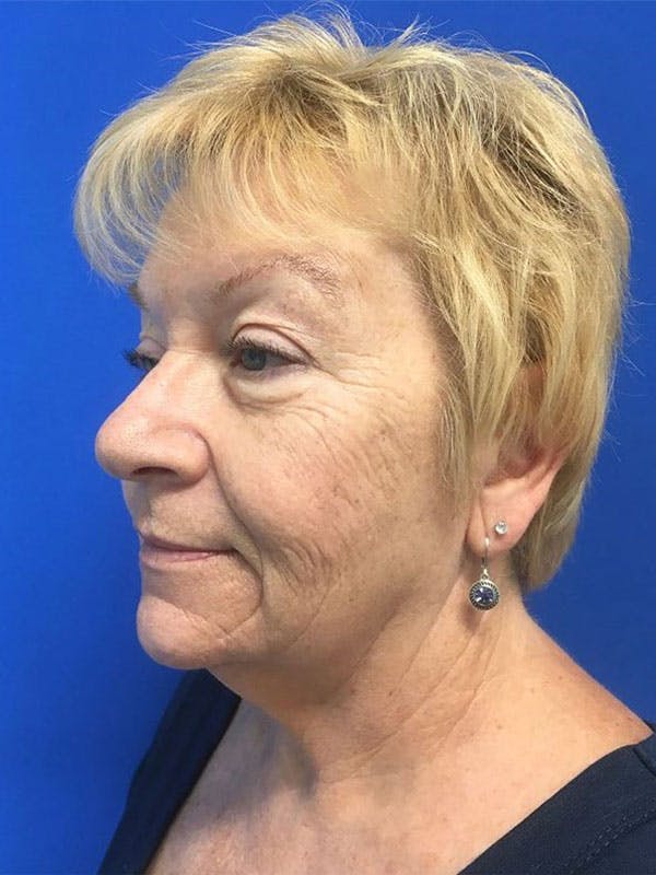 Face Lift Before & After Gallery - Patient 90356979 - Image 5