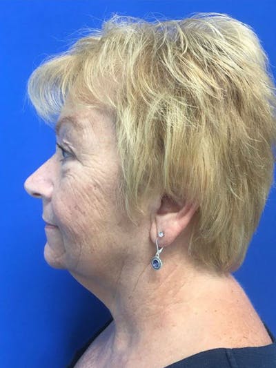Face Lift Before & After Gallery - Patient 90356979 - Image 1