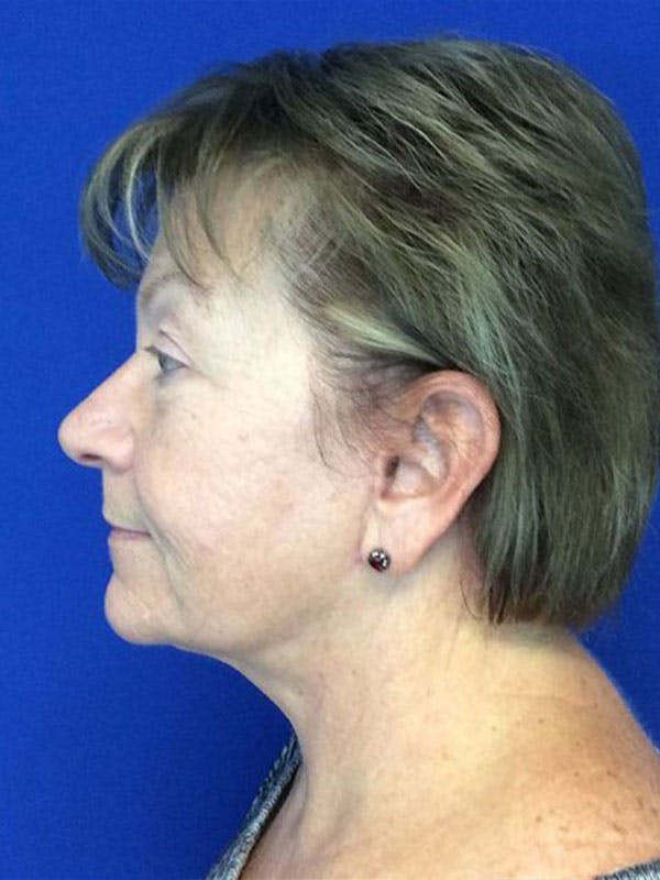 Face Lift Before & After Gallery - Patient 90356979 - Image 2