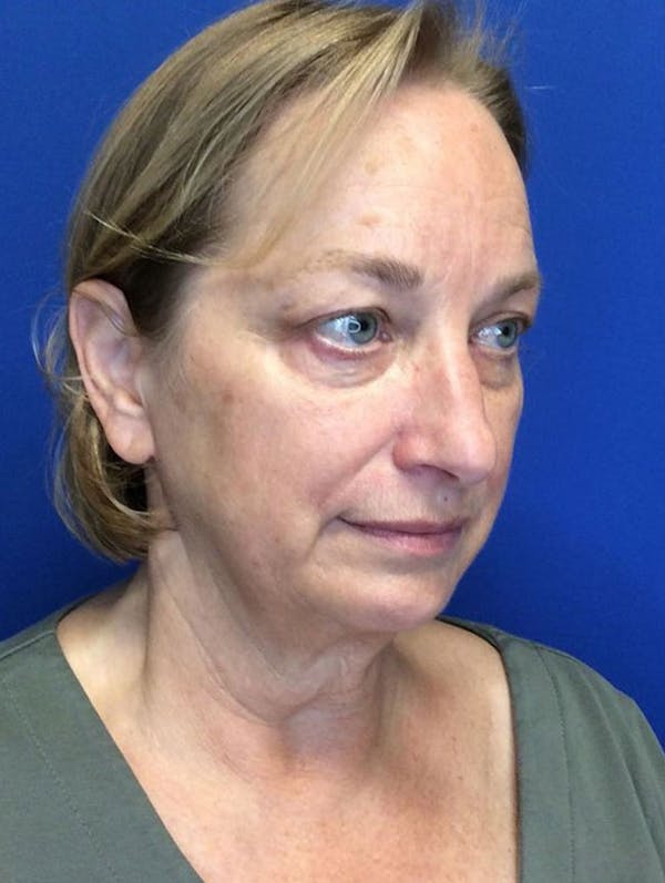 Face Lift Before & After Gallery - Patient 90393127 - Image 5
