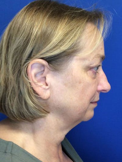 Face Lift Before & After Gallery - Patient 90393127 - Image 1
