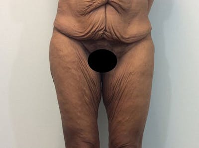 Thigh Lift Before & After Gallery - Patient 93246074 - Image 1