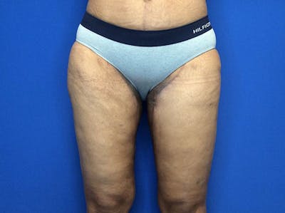 Thigh Lift Gallery - Patient 93246074 - Image 2