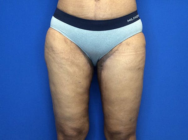 Thigh Lift Before & After Gallery - Patient 93246074 - Image 2