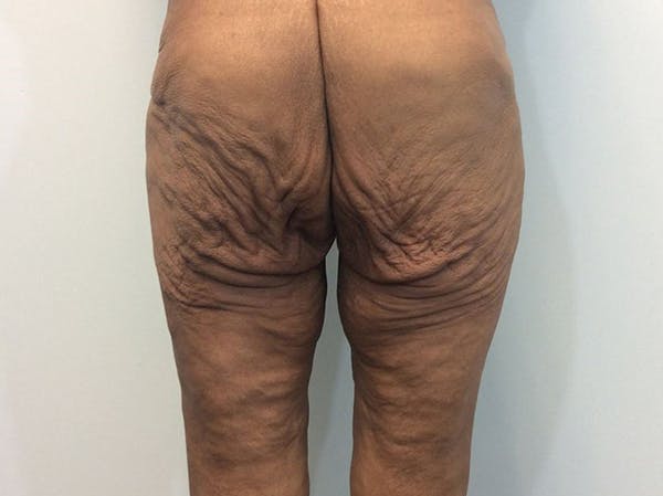 Thigh Lift Before & After Gallery - Patient 93246074 - Image 3