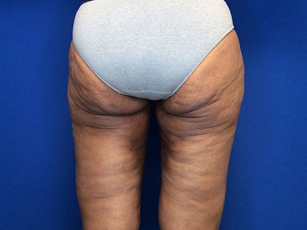 Thigh Lift Before & After Gallery - Patient 93246074 - Image 4