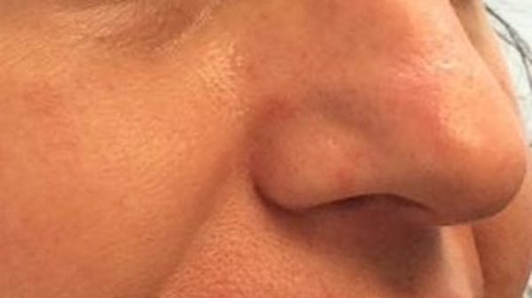 Laser Skin Resurfacing Before & After Gallery - Patient 93811490 - Image 2