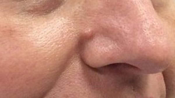 Laser Skin Resurfacing Before & After Gallery - Patient 93811490 - Image 1