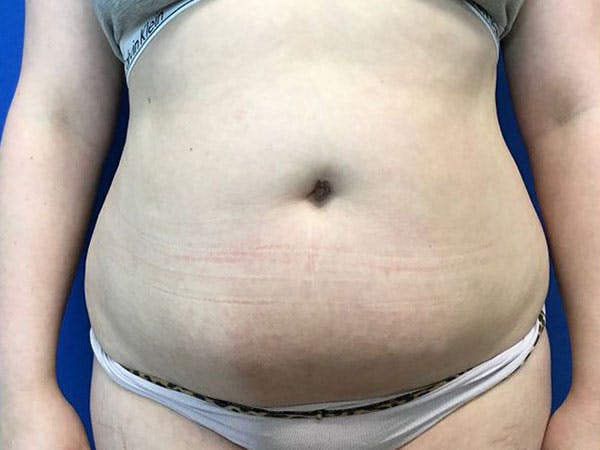 Liposuction Before & After Gallery - Patient 99346052 - Image 1