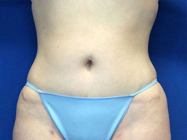 Tummy Tuck (Abdominoplasty) Before & After Gallery - Patient 99346024 - Image 2