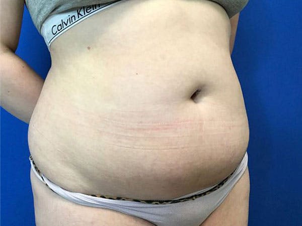 Tummy Tuck (Abdominoplasty) Before & After Gallery - Patient 99346024 - Image 3