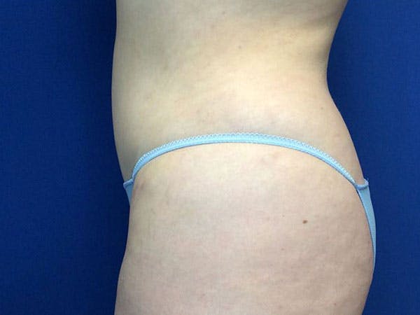 Tummy Tuck (Abdominoplasty) Before & After Gallery - Patient 99346024 - Image 6
