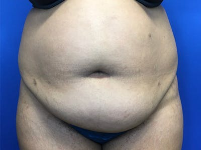 Liposuction Before & After Gallery - Patient 102905461 - Image 1