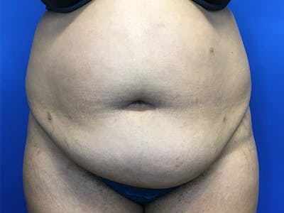 Liposuction Gallery - Patient 102905461 - Image 1