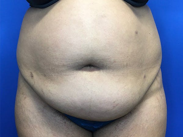 Liposuction Before & After Gallery - Patient 102905461 - Image 1
